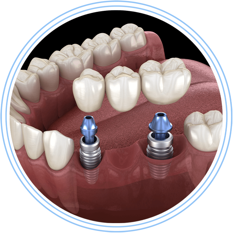 dental bridge 3d
