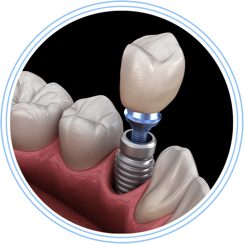 dental implant 3d