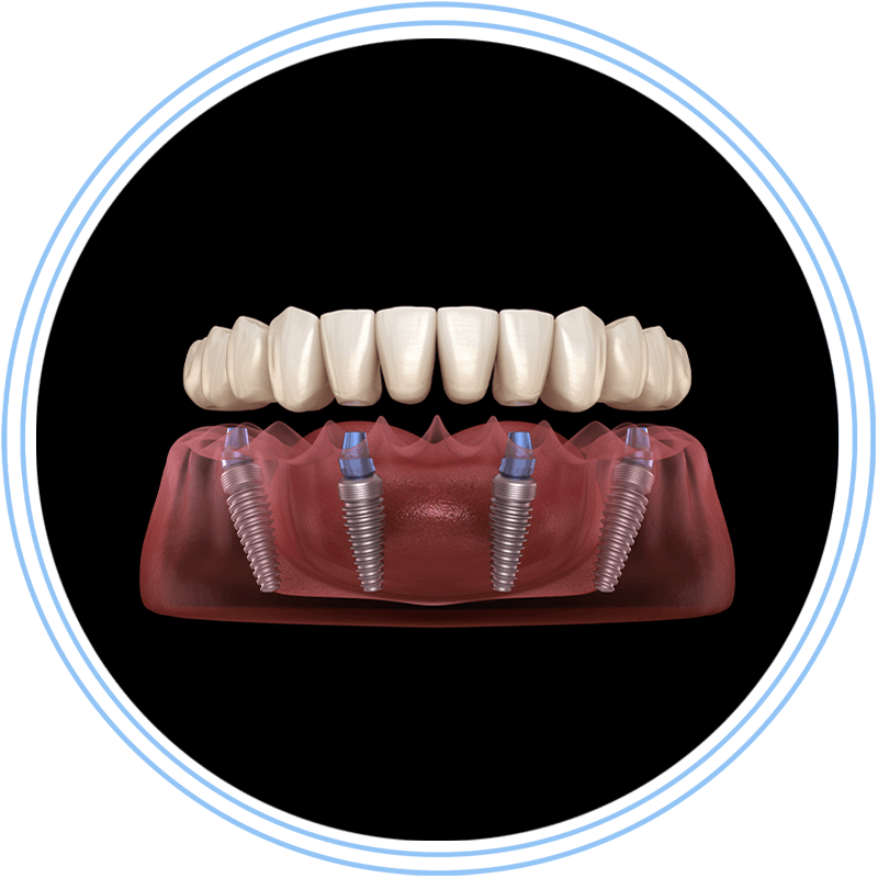 full arch 3d