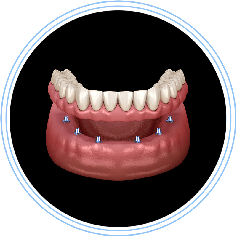 implant supported